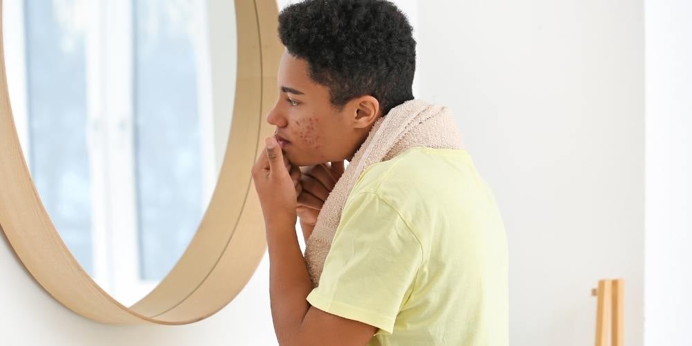 adolescentes-problemas-de-acne