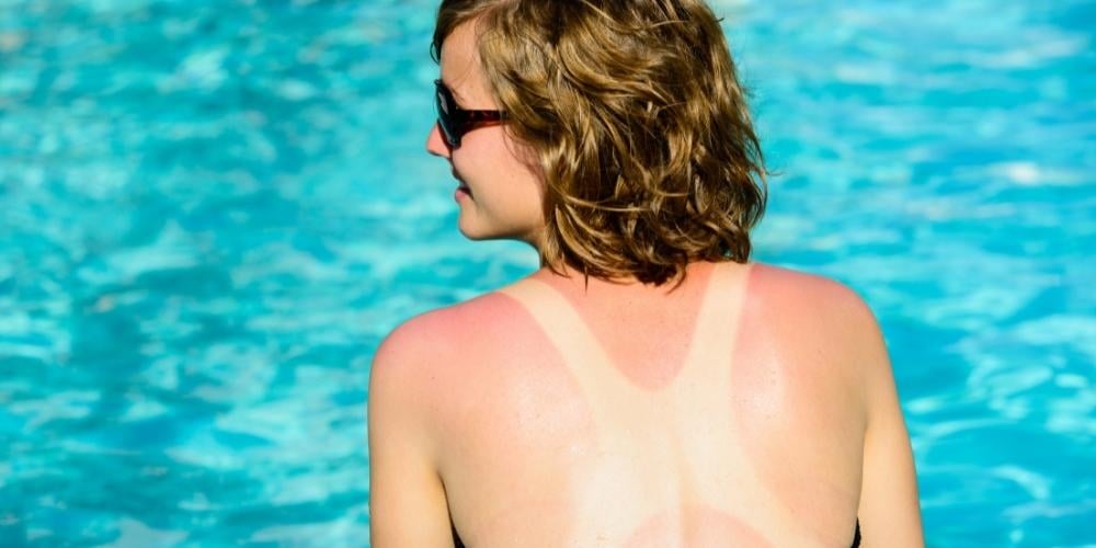 quemaduras-de-sol-marca-playa-crema-sola